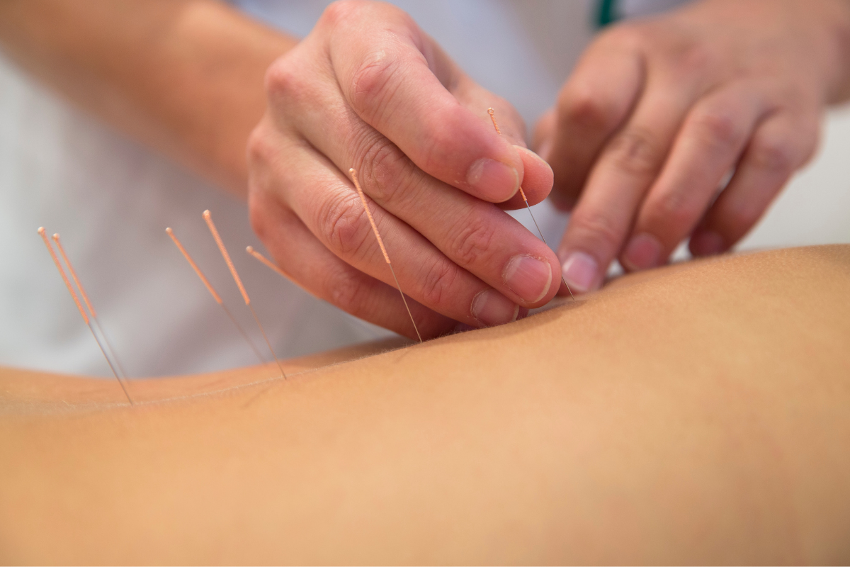 Acupuncture at Purity Acupuncture & Holistic Wellness, Asheville, NC
