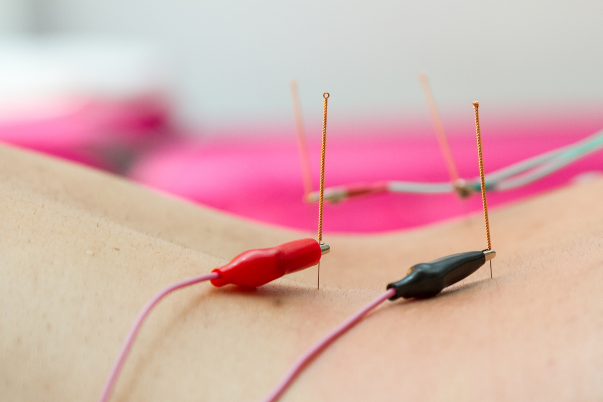Electrical Stimulation Acupuncture at Purity Acupuncture & Holistic Wellness in Asheville, NC